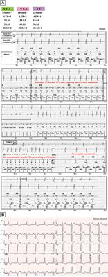 Case Report: A Rare Complication Following Catheter Ablation of Scar-Related Ventricular Tachycardia